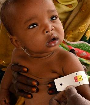 Desnutrición infantil Un bebé